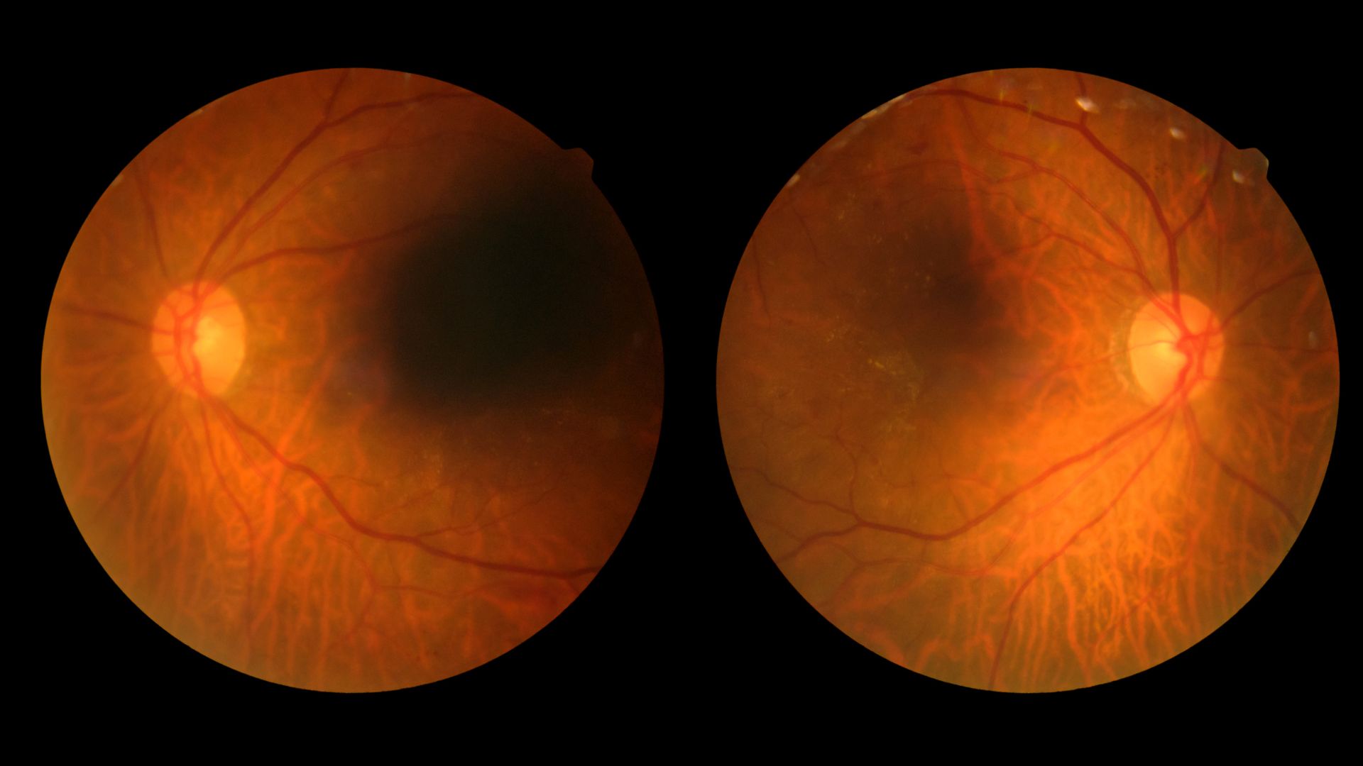 Diabetic Retinopathy